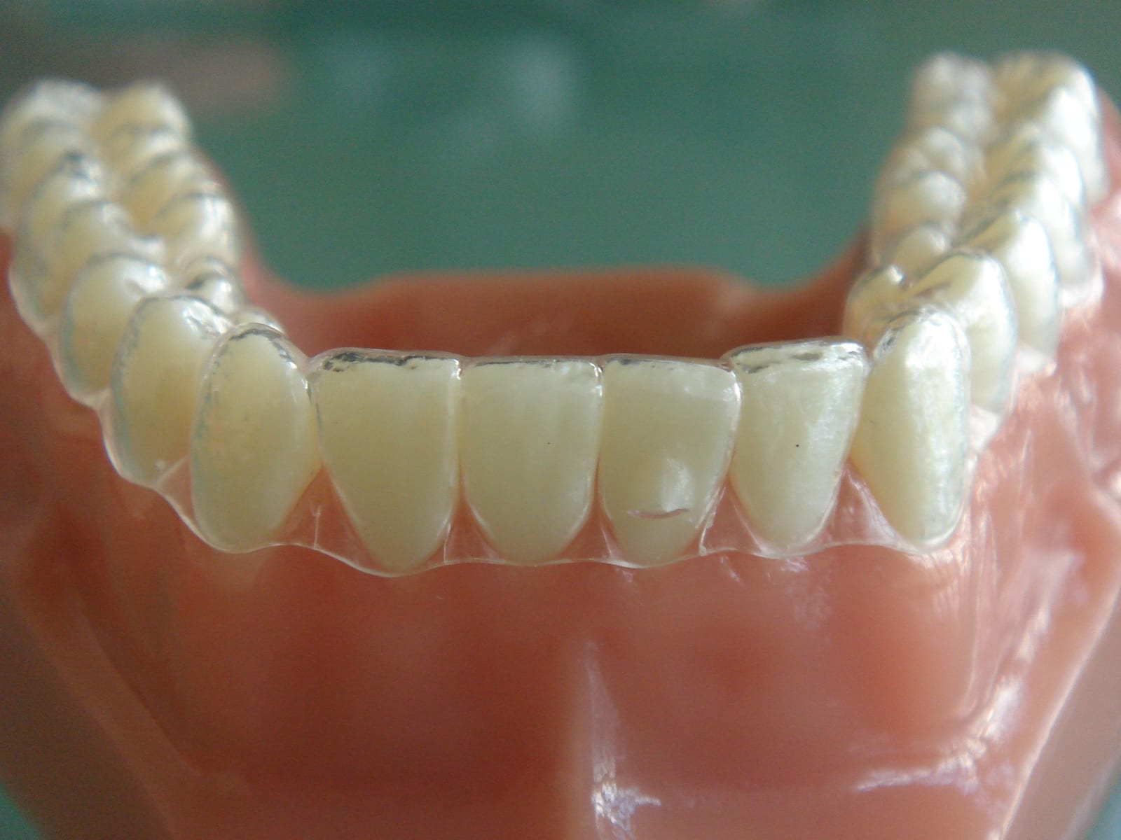 Retainers Orthodontics at Bristol Dental Specialists